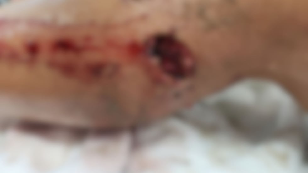 An 11-year-old boy in Atkinson County underwent several hours of surgery after reportedly...