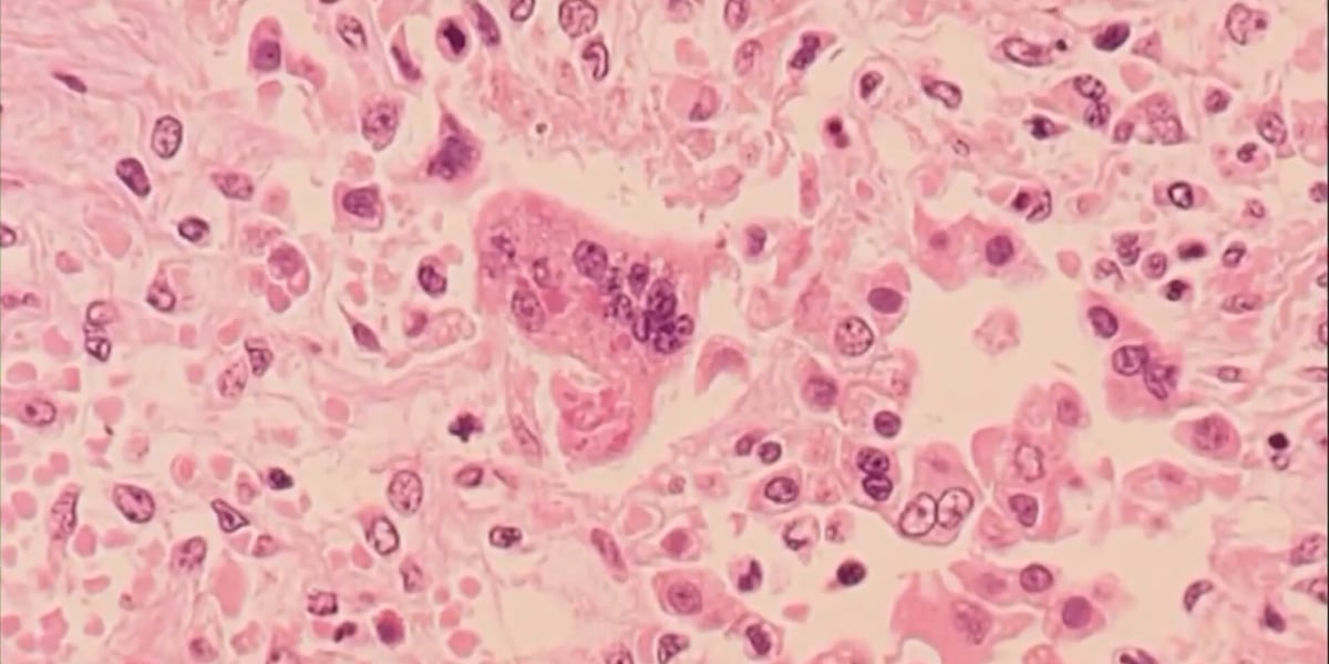 5th case of measles reported in Georgia, Department of Public Health says
