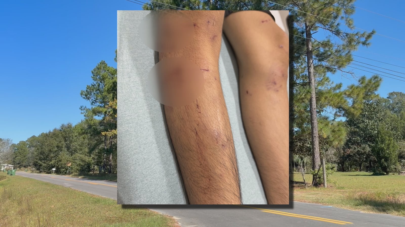 A teen was attacked by a pack of feral dogs in Colquitt County in late September, and his...