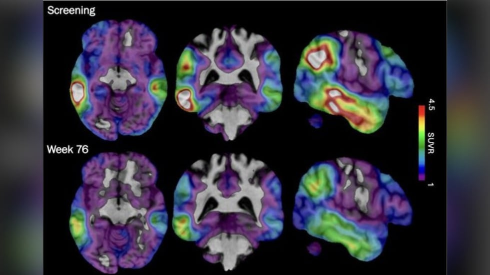 These brain scan images provided by Biogen show how high levels of Alzheimer's-related tau...