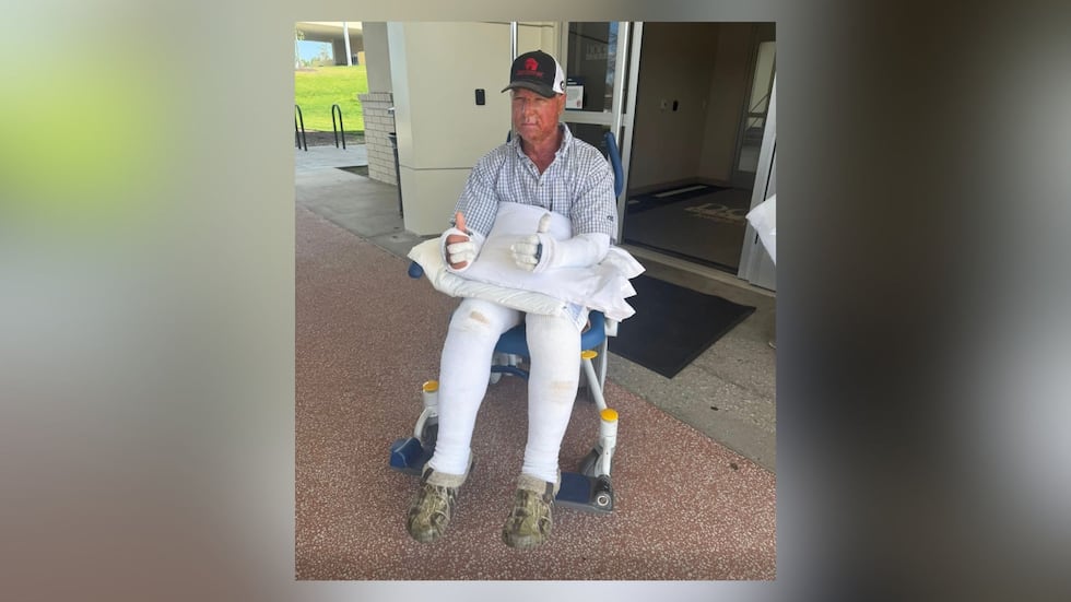 A Worth County man is recovering after suffering severe burns during a controlled burn.