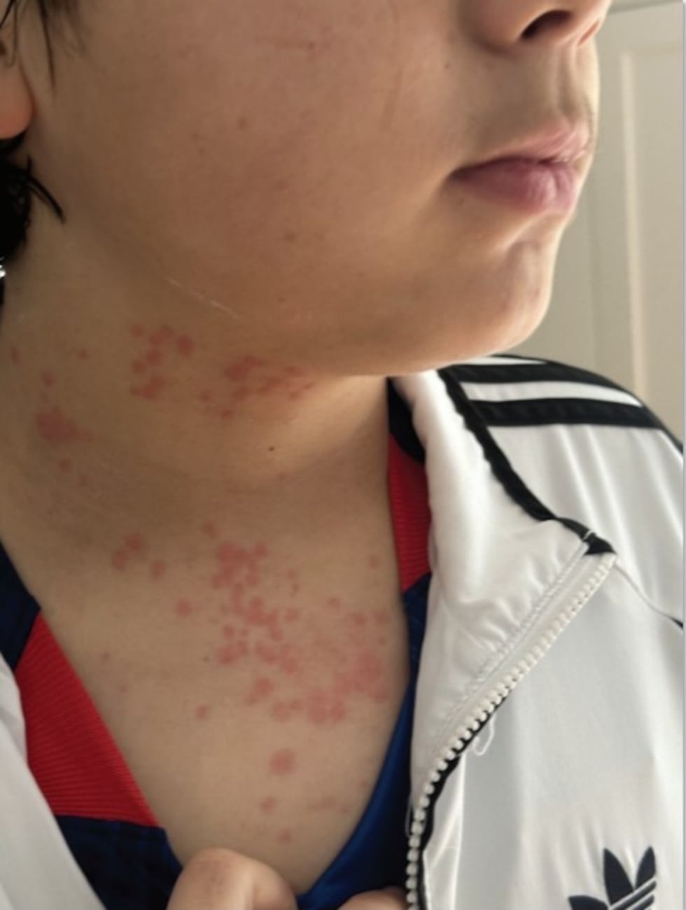 The lawsuit states all members of the family including the kids experienced welts and rashes...